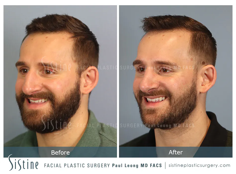 Rhinoplasty Before and After | Leong Facial Plastic Surgery