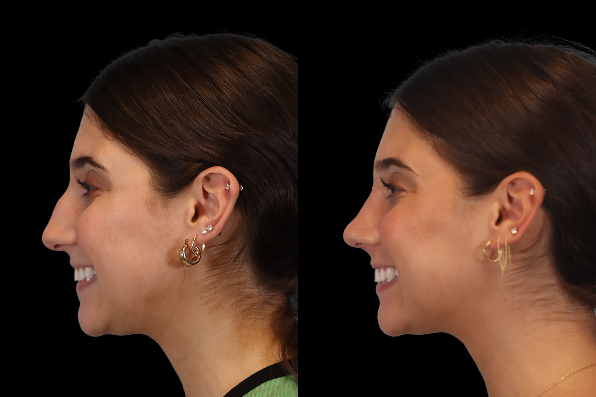 Nose Changes With Age - Preoperative View | Dr. Paul Leong