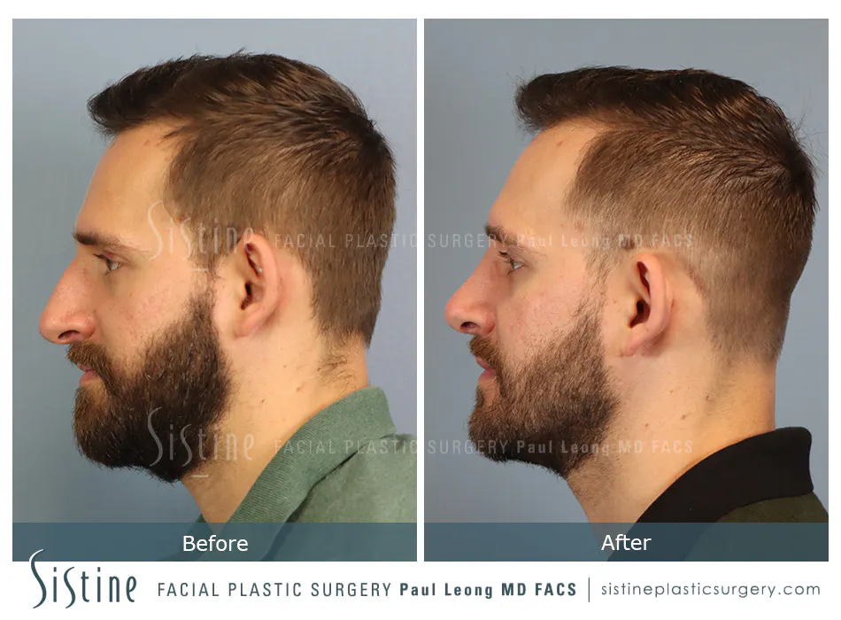 Rhinoplasty Before and After | Leong Facial Plastic Surgery
