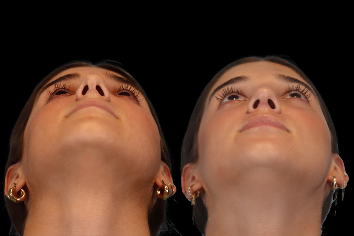 Rhinoplasty for Breathing - Preoperative View | Dr. Paul Leong