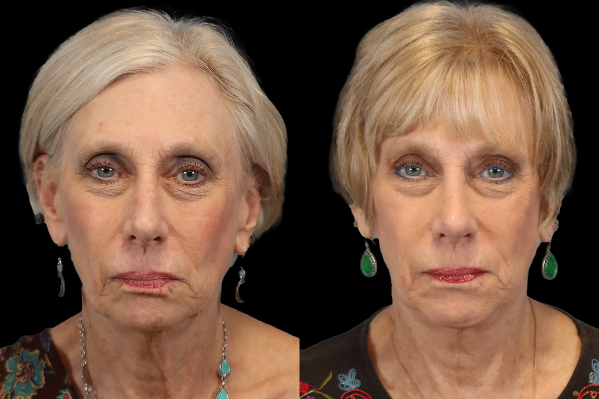 Rhinoplasty Before and After | Leong Facial Plastic Surgery