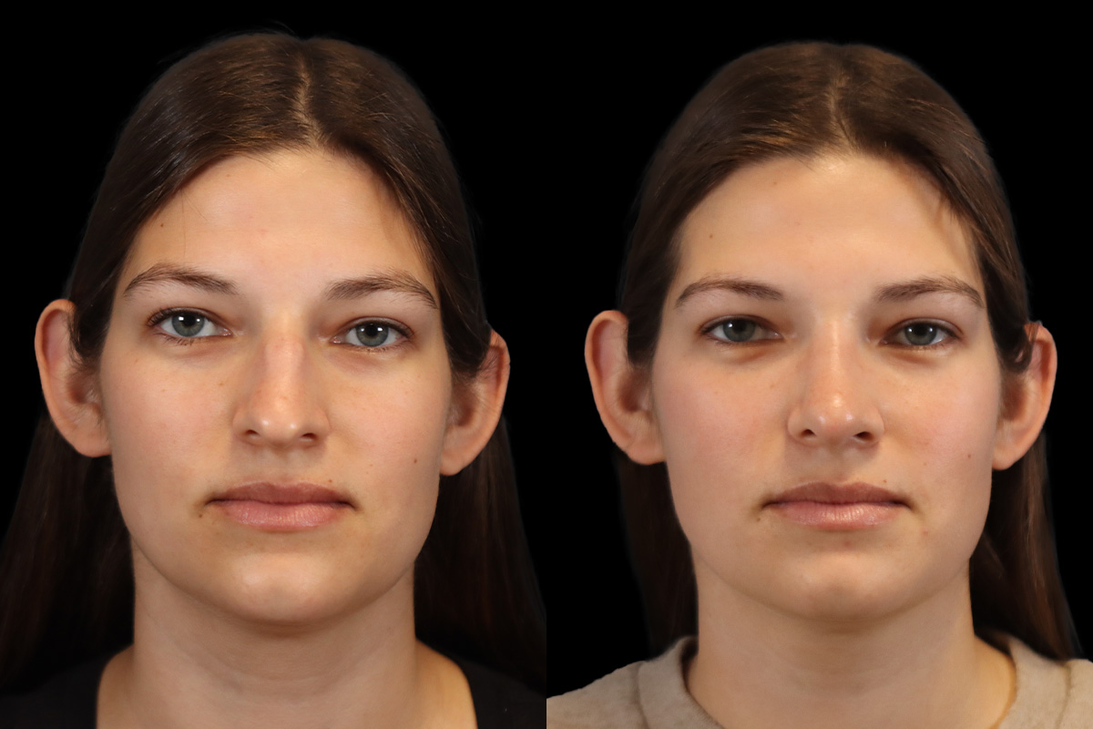 Rhinoplasty Before and After | Leong Facial Plastic Surgery