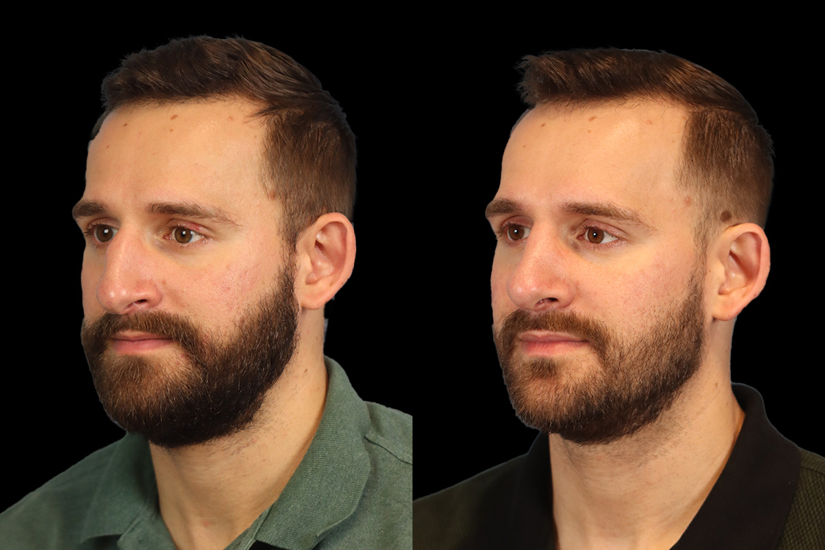 Rhinoplasty Before and After | Leong Facial Plastic Surgery