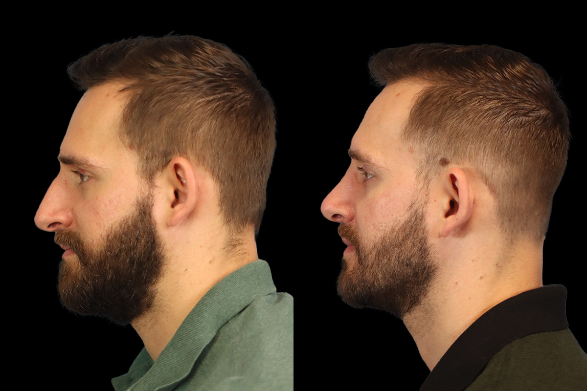 Rhinoplasty Before and After | Leong Facial Plastic Surgery