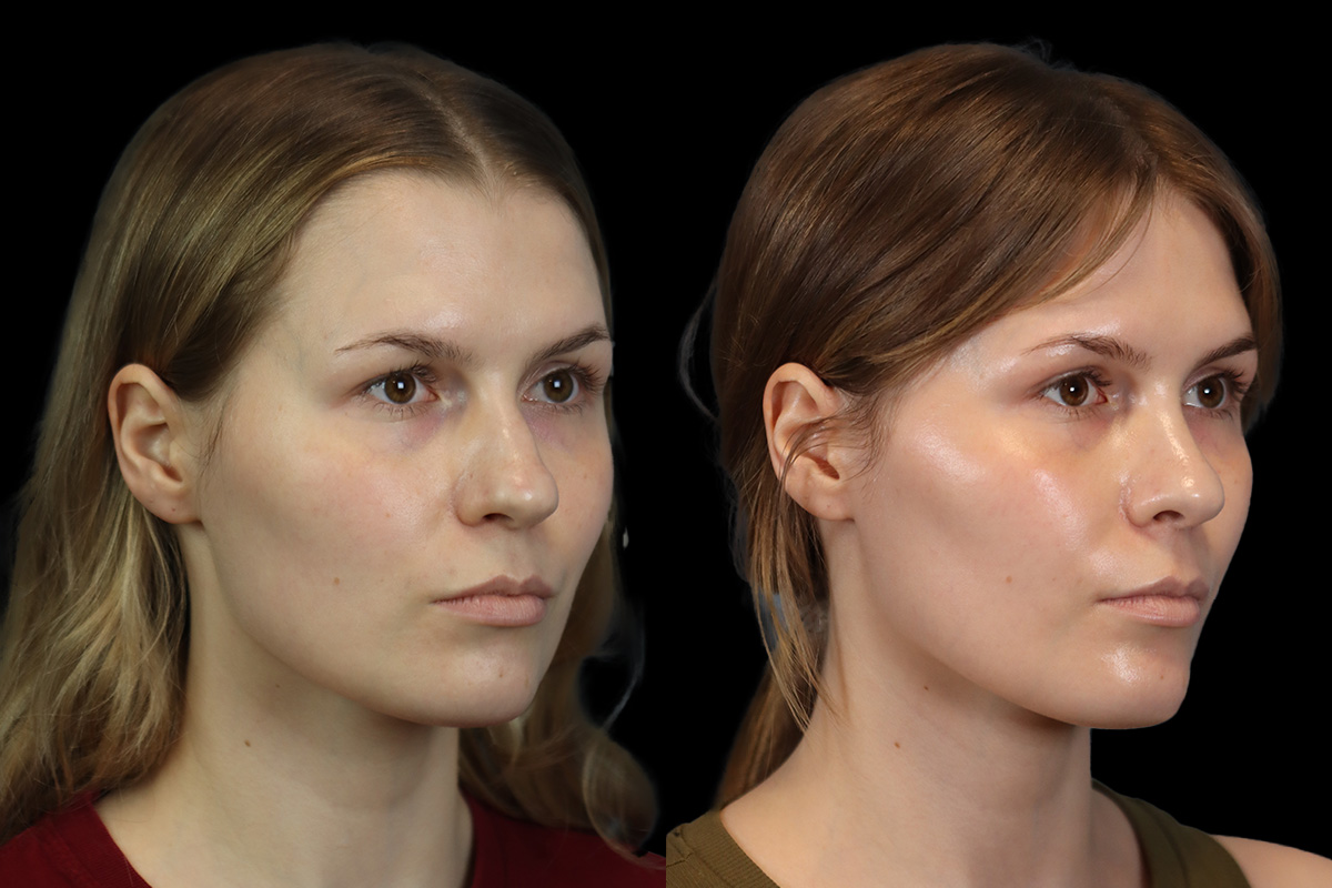 Rhinoplasty Before and After | Leong Facial Plastic Surgery