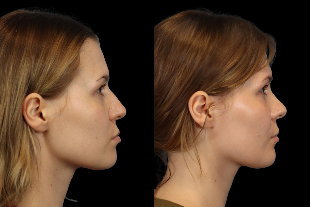 Rhinoplasty Before and After | Leong Facial Plastic Surgery