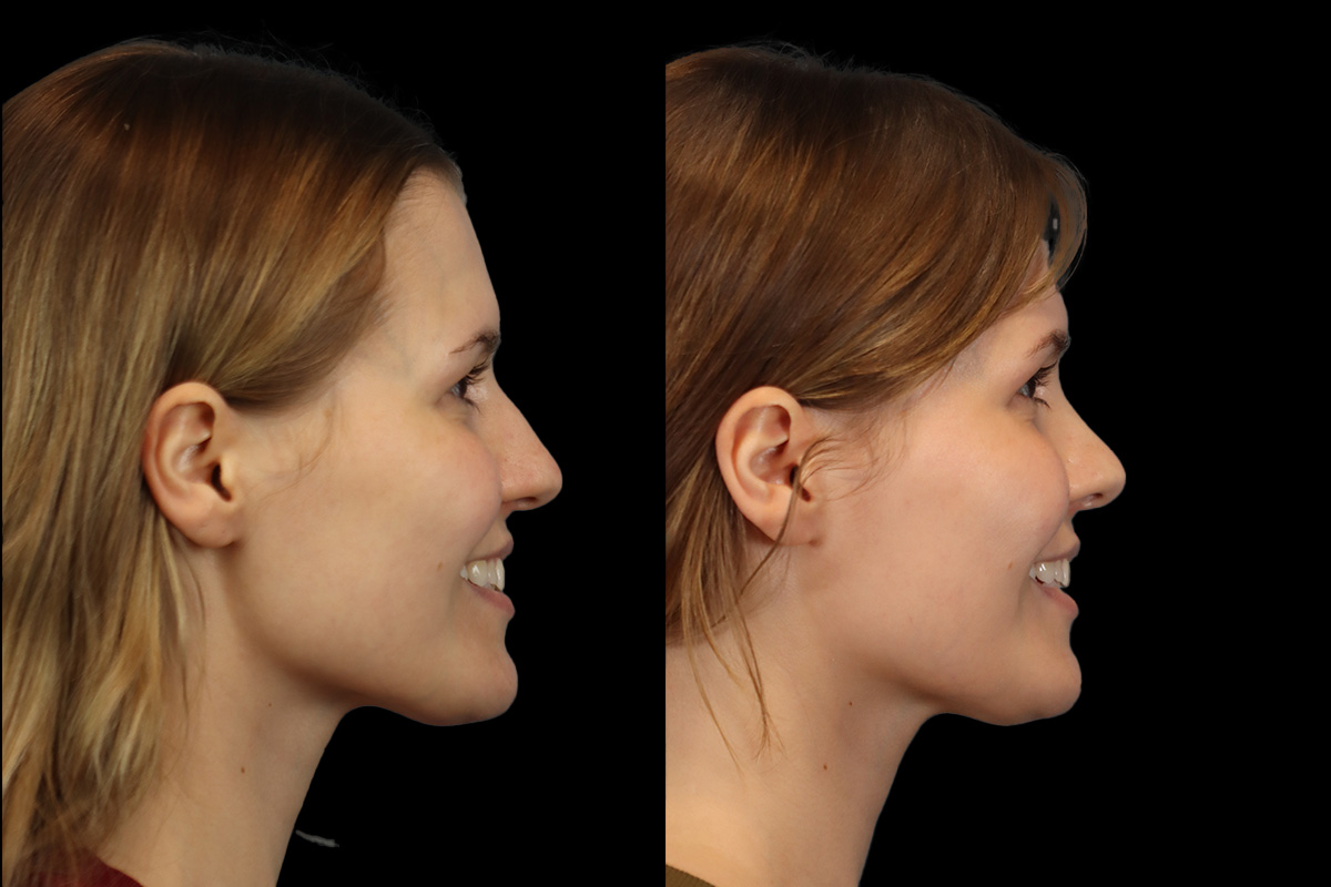 Rhinoplasty Before and After | Leong Facial Plastic Surgery
