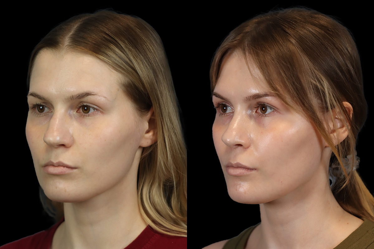 Rhinoplasty Before and After | Leong Facial Plastic Surgery