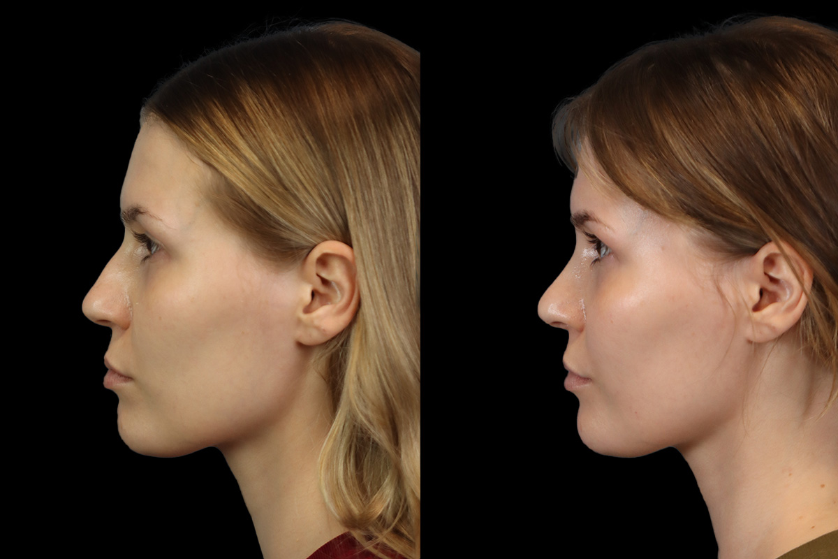 Rhinoplasty Before and After | Leong Facial Plastic Surgery