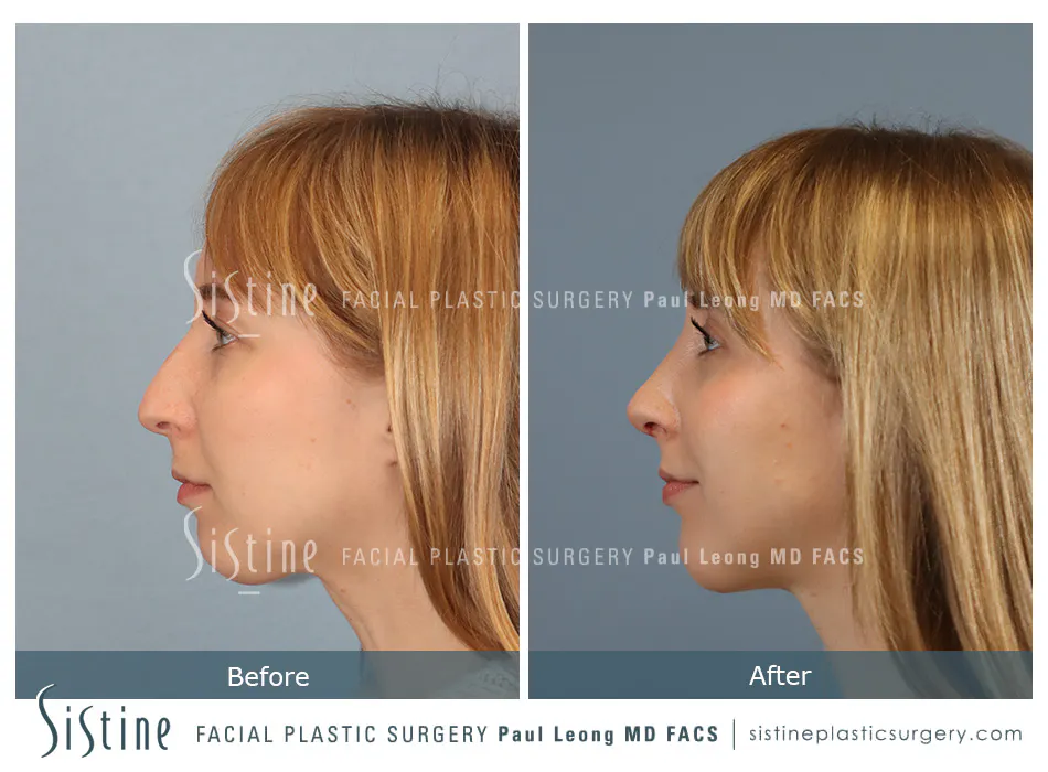 Rhinoplasty Before and After | Leong Facial Plastic Surgery