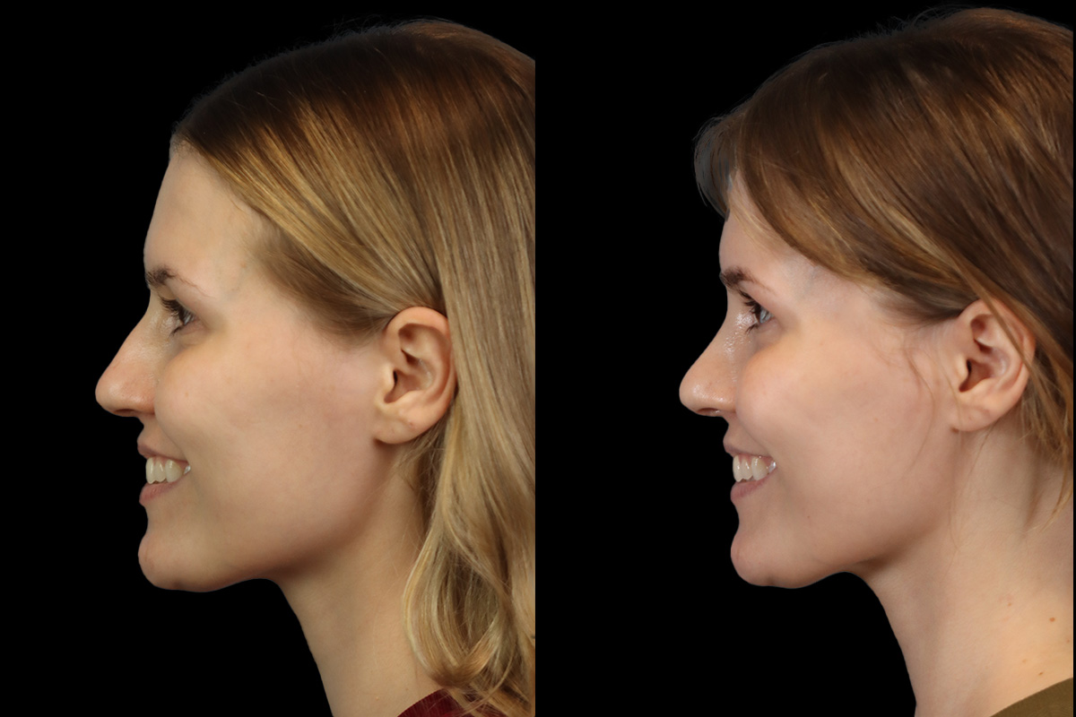 Rhinoplasty Before and After | Leong Facial Plastic Surgery