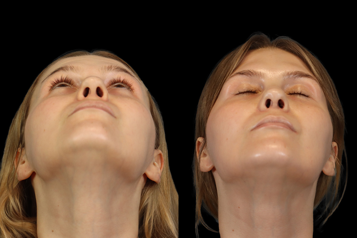 Rhinoplasty Before and After | Leong Facial Plastic Surgery