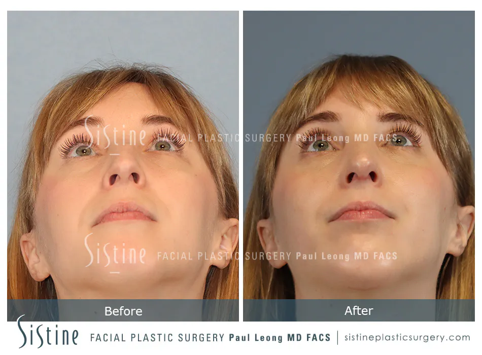Rhinoplasty Before and After | Leong Facial Plastic Surgery