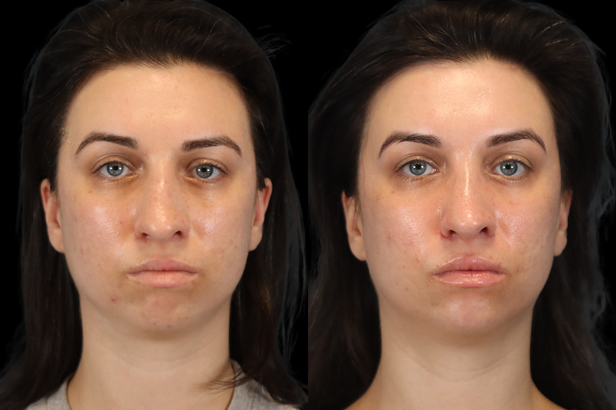 Rhinoplasty Before and After | Leong Facial Plastic Surgery