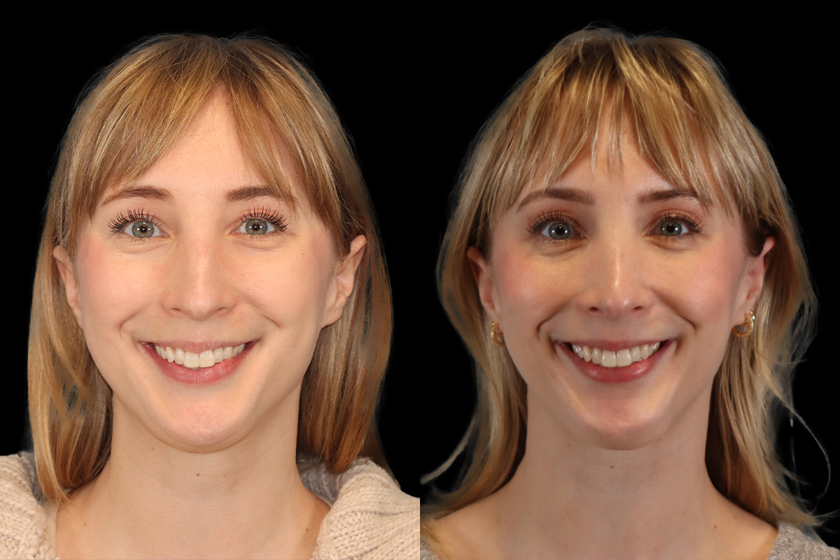 Rhinoplasty Before and After | Leong Facial Plastic Surgery