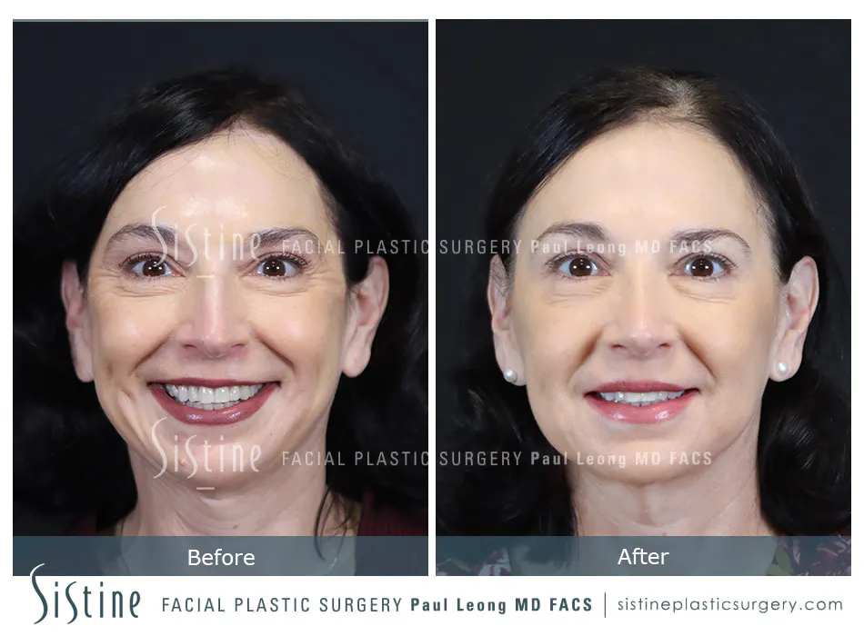 Rhinoplasty Before and After | Leong Facial Plastic Surgery