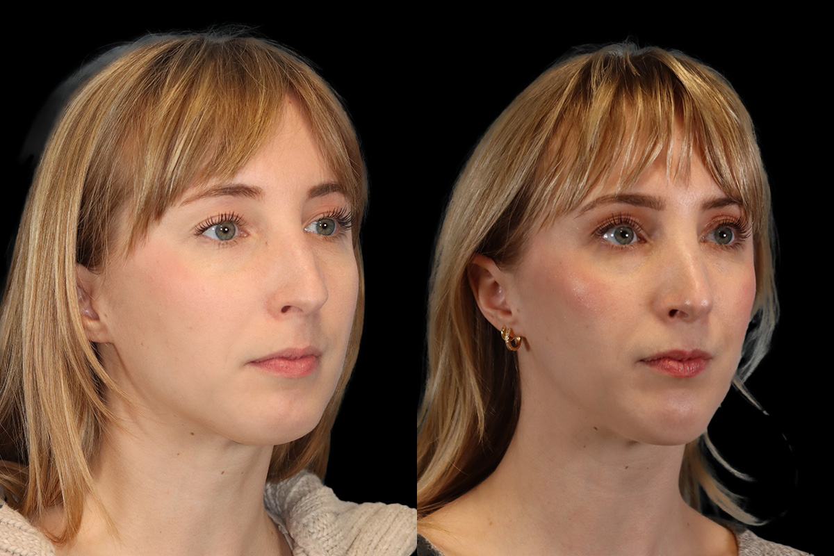 Rhinoplasty Before and After | Leong Facial Plastic Surgery
