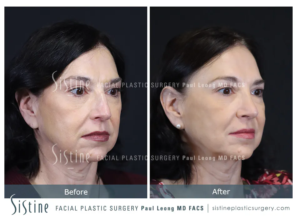 Rhinoplasty Before and After | Leong Facial Plastic Surgery