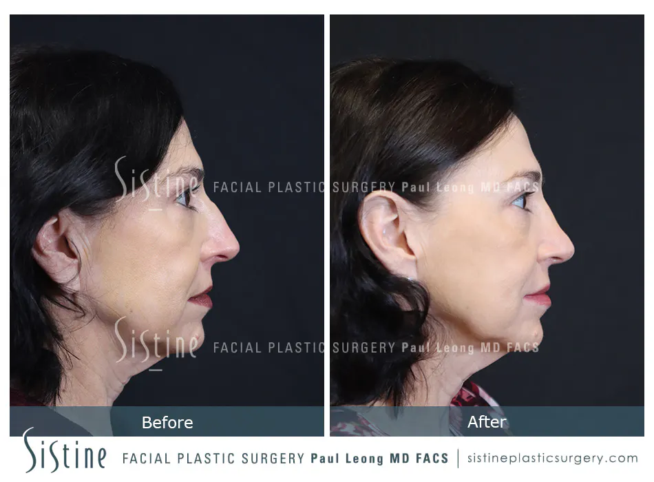 Rhinoplasty Before and After | Leong Facial Plastic Surgery