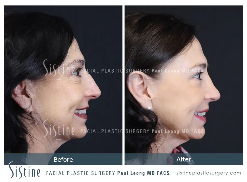 Rhinoplasty Before and After | Leong Facial Plastic Surgery