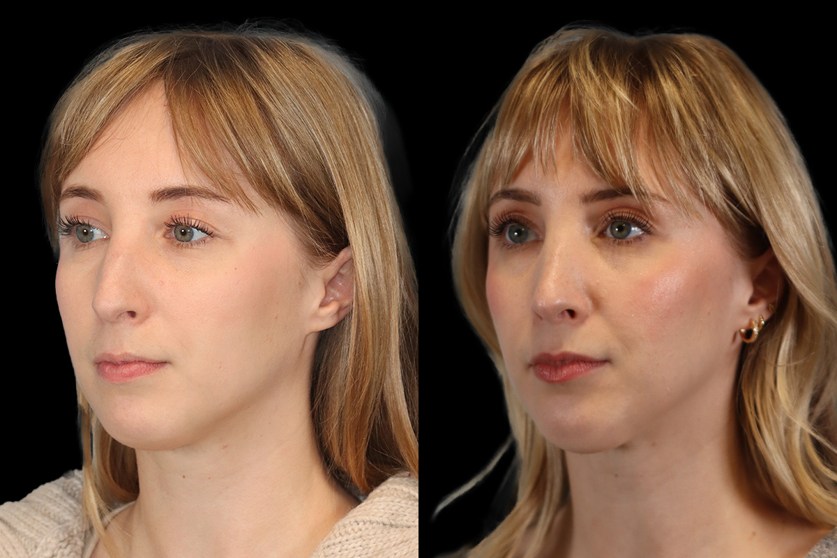 Rhinoplasty Before and After | Leong Facial Plastic Surgery