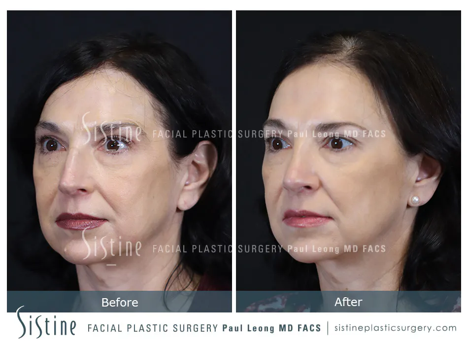 Rhinoplasty Before and After | Leong Facial Plastic Surgery