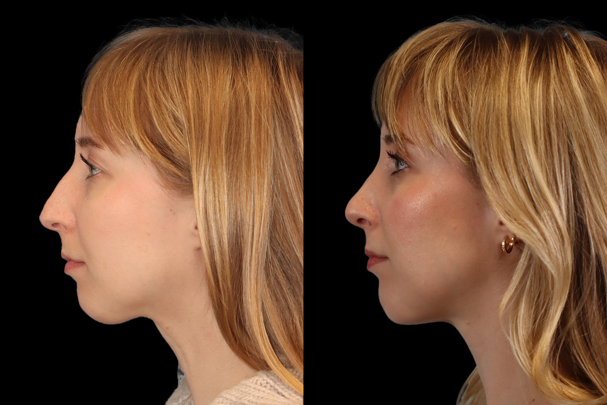 Rhinoplasty Before and After | Leong Facial Plastic Surgery