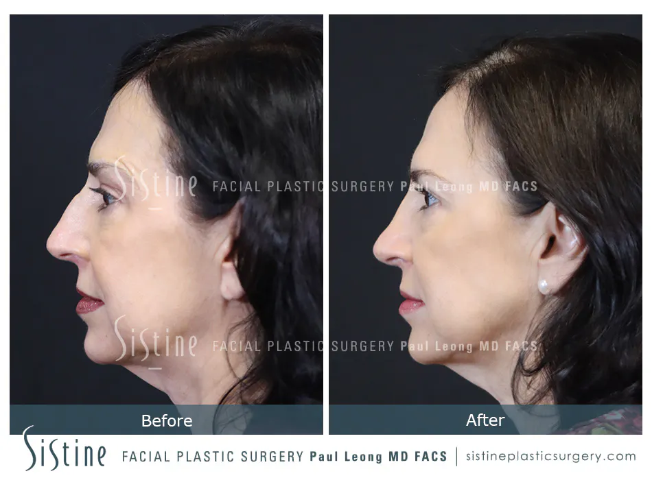 Rhinoplasty Before and After | Leong Facial Plastic Surgery