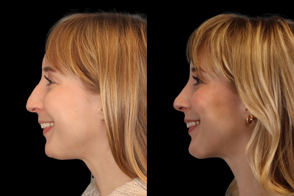 Rhinoplasty Before and After | Leong Facial Plastic Surgery