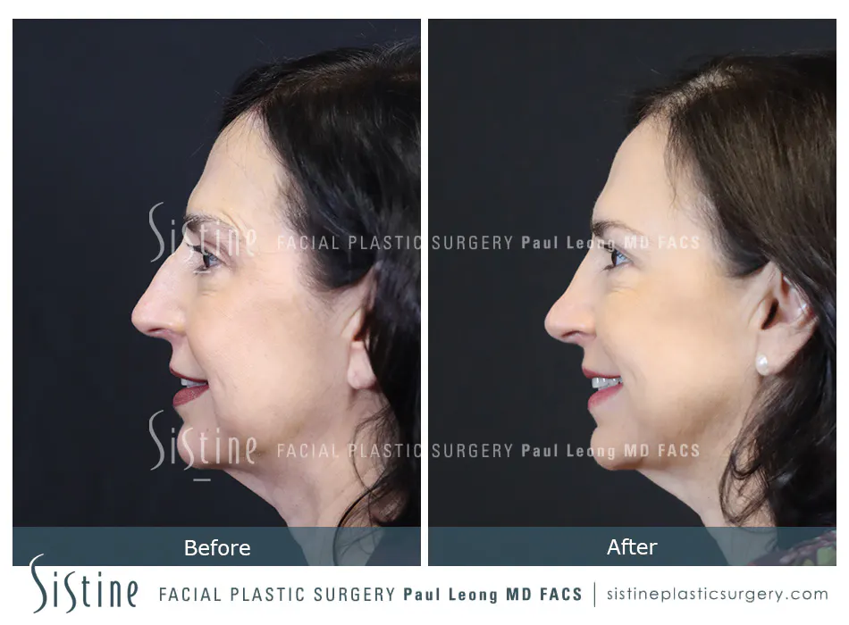 Rhinoplasty Before and After | Leong Facial Plastic Surgery
