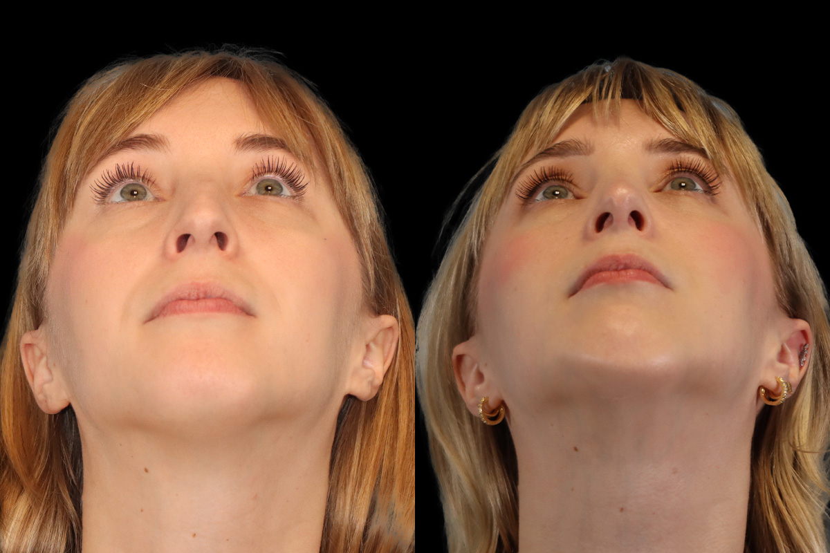 Rhinoplasty Before and After | Leong Facial Plastic Surgery