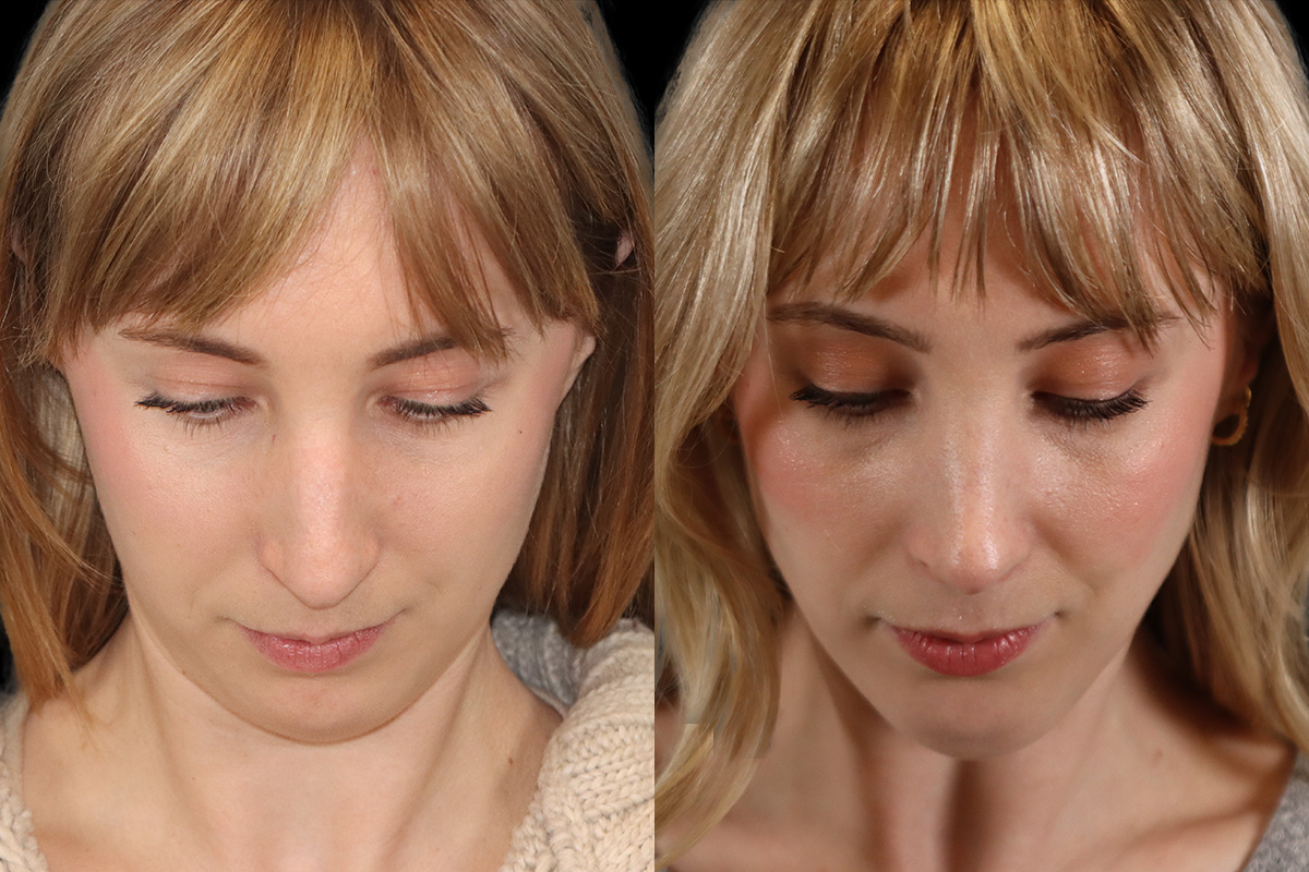 Rhinoplasty Before and After | Leong Facial Plastic Surgery