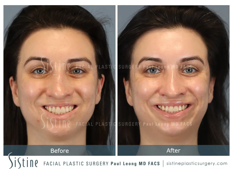 Rhinoplasty Before and After | Leong Facial Plastic Surgery