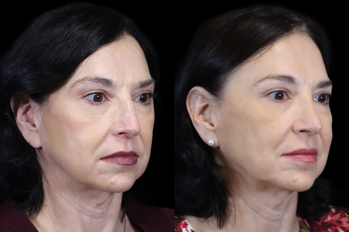 Rhinoplasty Before and After | Leong Facial Plastic Surgery