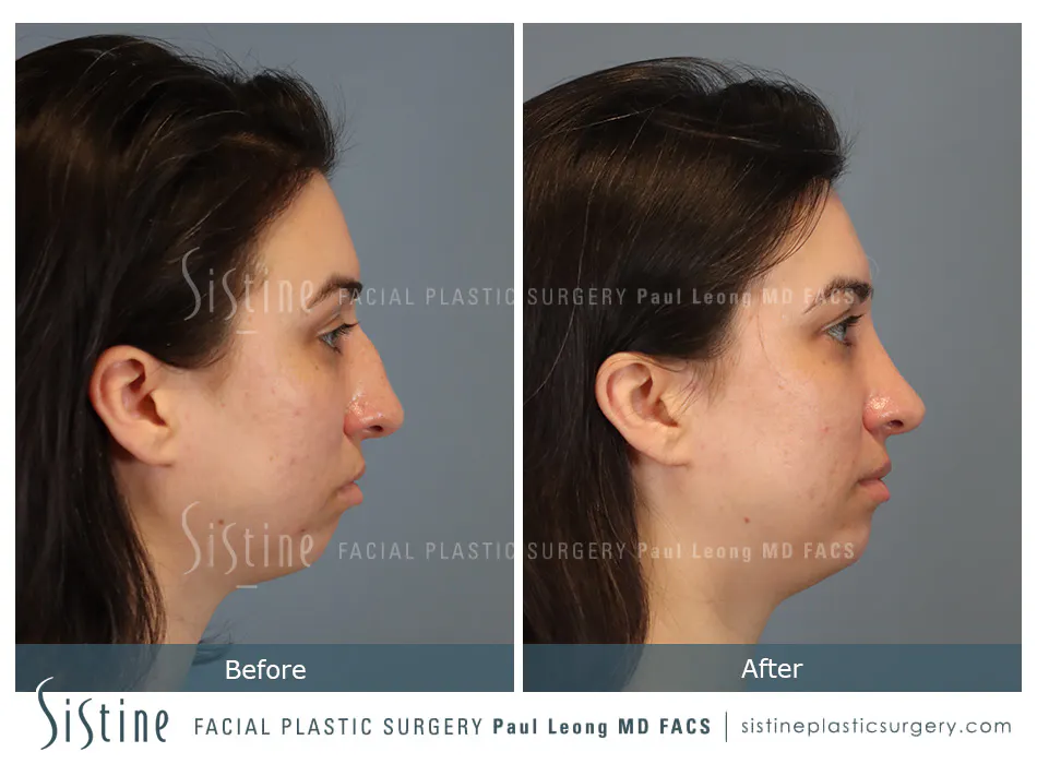 Rhinoplasty Before and After | Leong Facial Plastic Surgery