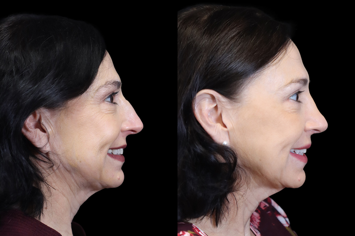 Rhinoplasty Before and After | Leong Facial Plastic Surgery