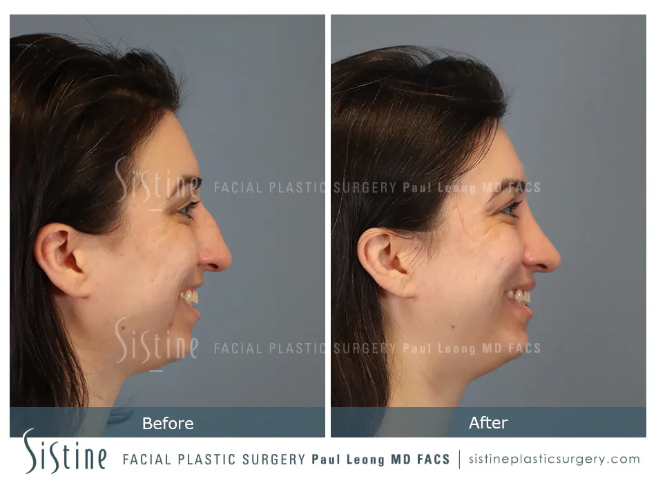 Rhinoplasty Before and After | Leong Facial Plastic Surgery