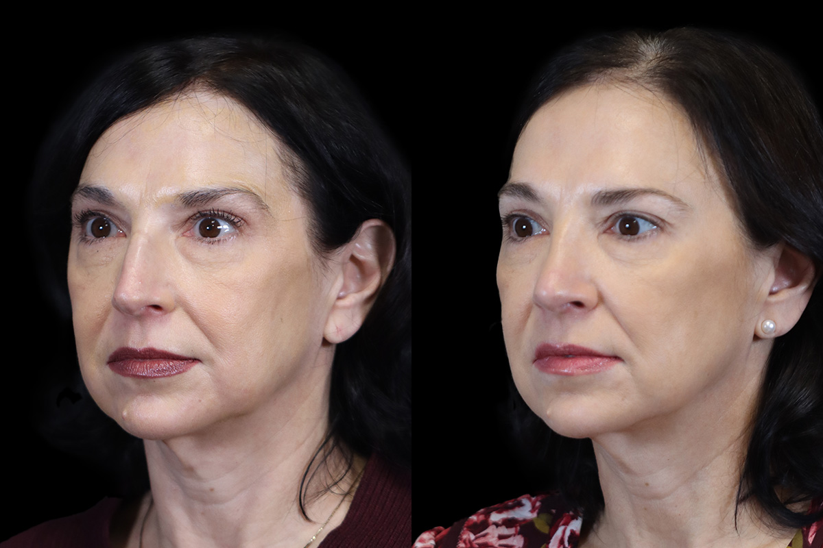 Rhinoplasty Before and After | Leong Facial Plastic Surgery