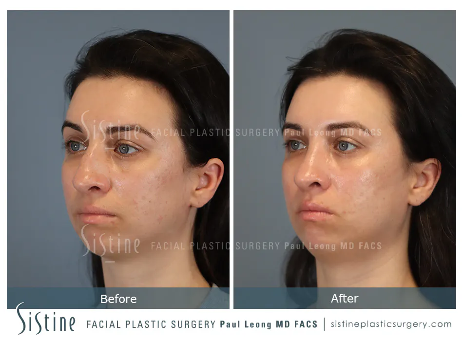 Rhinoplasty Before and After | Leong Facial Plastic Surgery