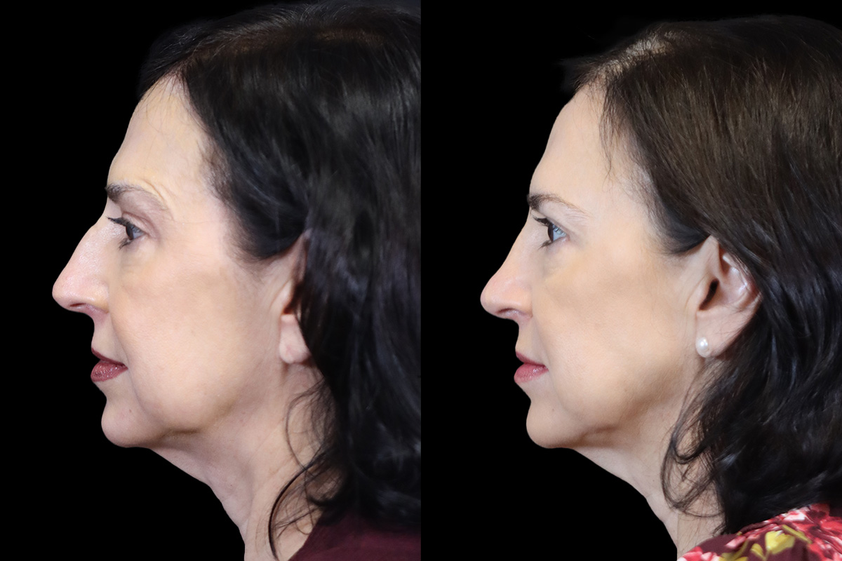 Rhinoplasty Before and After | Leong Facial Plastic Surgery