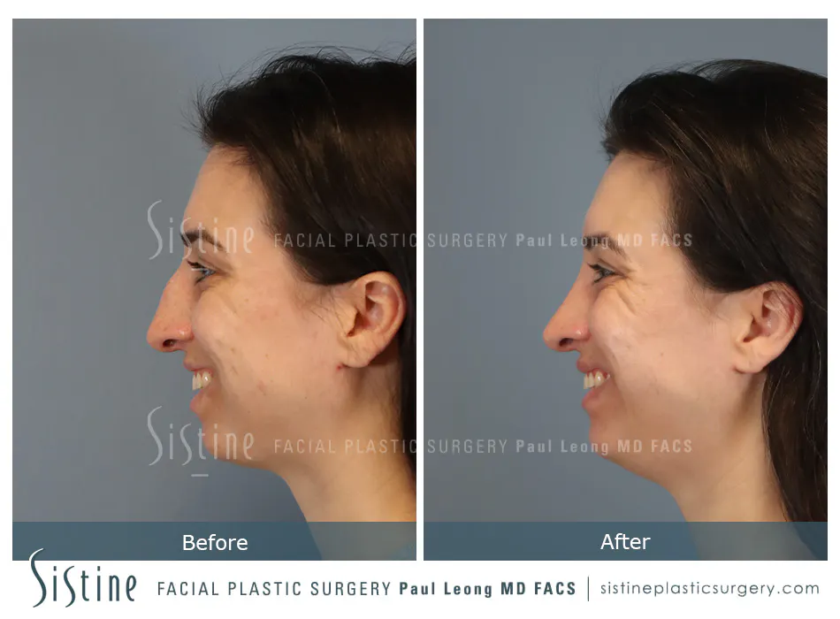 Rhinoplasty Before and After | Leong Facial Plastic Surgery