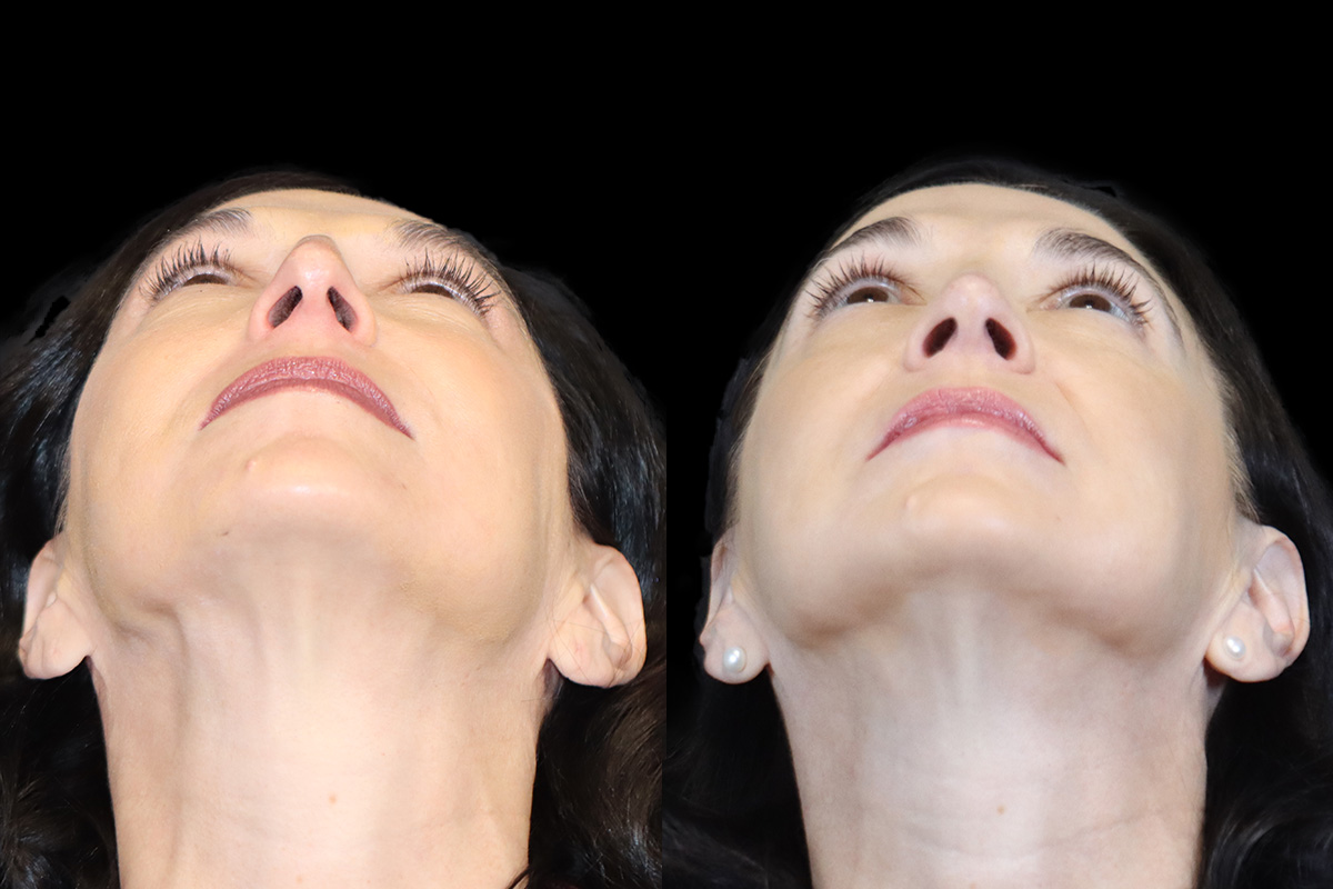 Rhinoplasty Before and After | Leong Facial Plastic Surgery