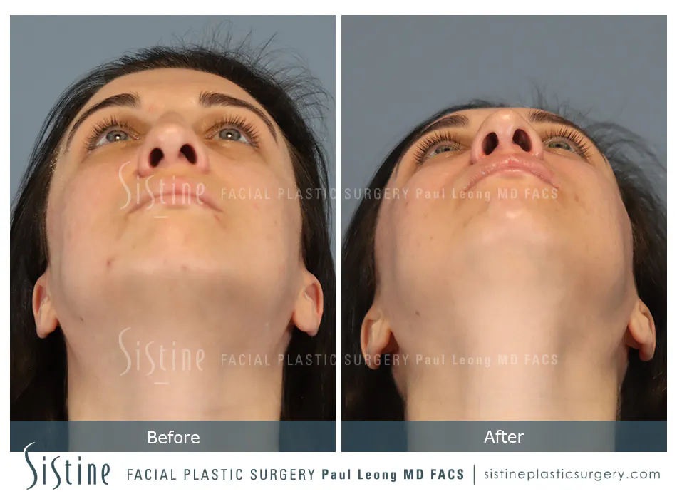 Rhinoplasty Before and After | Leong Facial Plastic Surgery