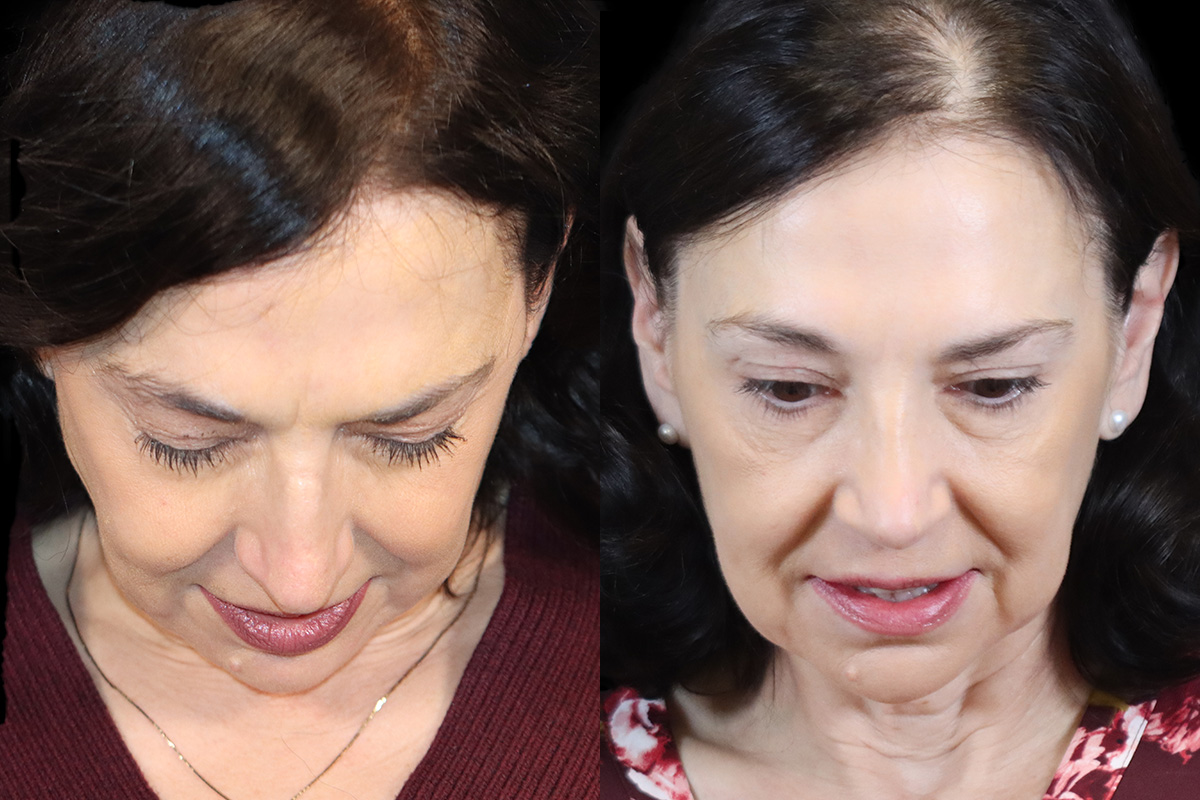 Rhinoplasty Before and After | Leong Facial Plastic Surgery