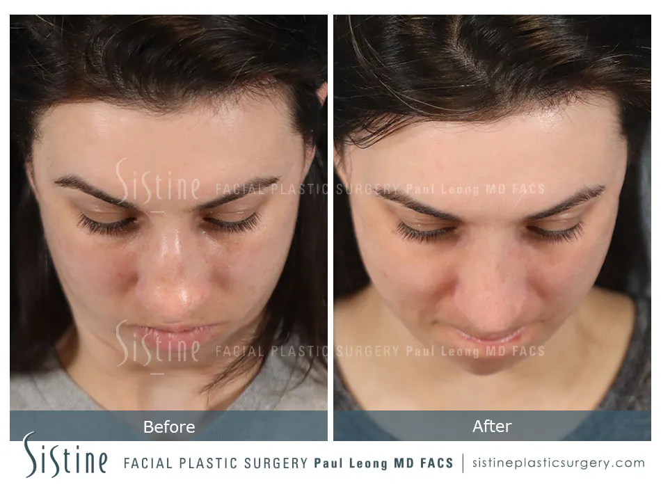 Rhinoplasty Before and After | Leong Facial Plastic Surgery