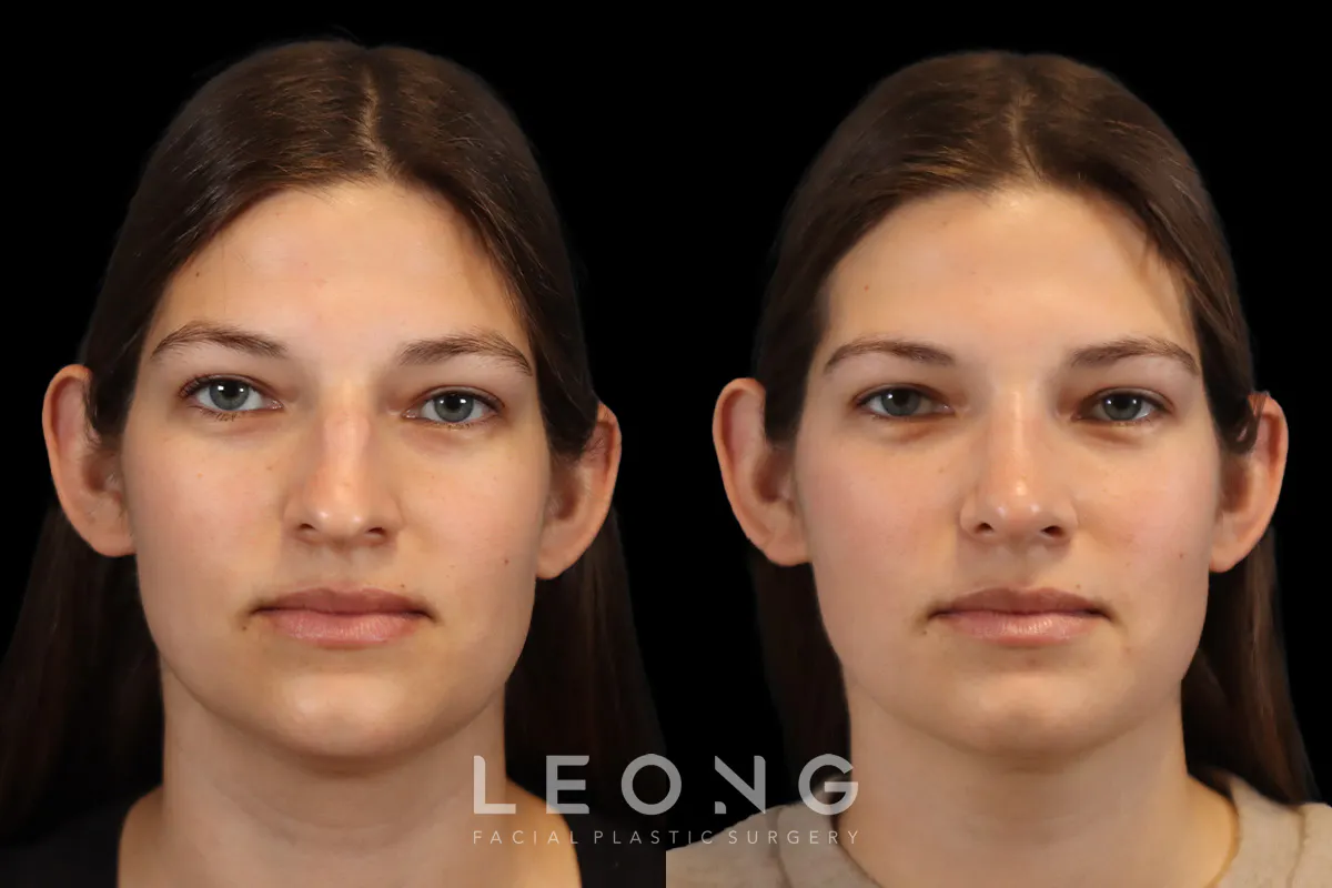 Rhinoplasty Before and After | Leong Facial Plastic Surgery