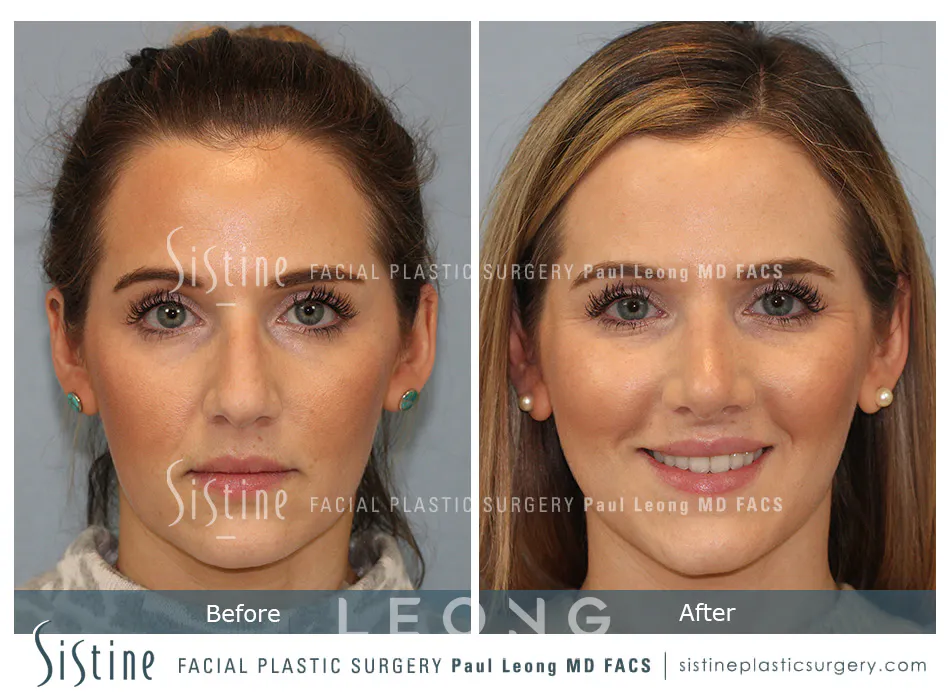 Rhinoplasty Before and After | Leong Facial Plastic Surgery