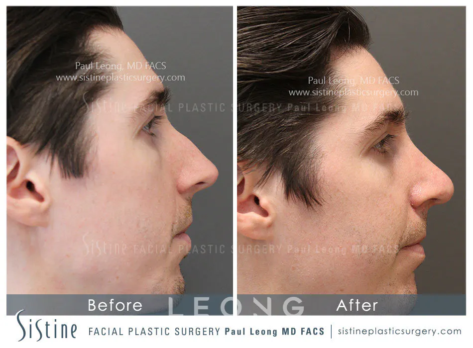 Rhinoplasty Before and After | Leong Facial Plastic Surgery