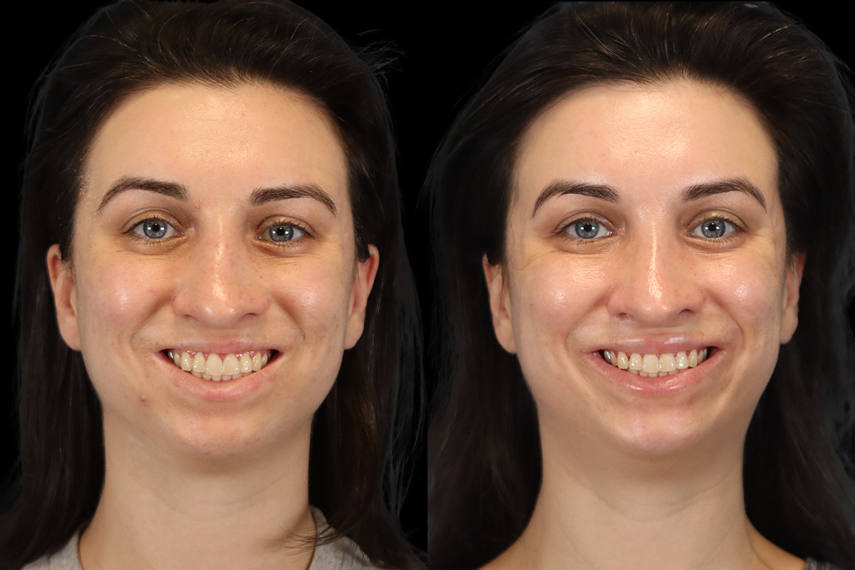 Rhinoplasty Before and After | Leong Facial Plastic Surgery