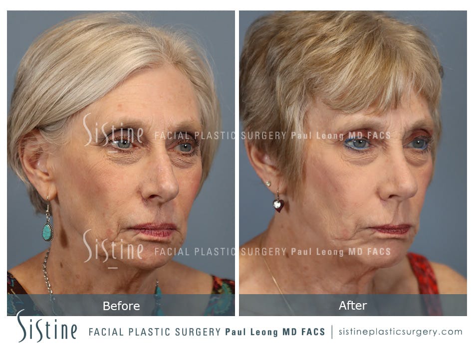 Rhinoplasty Before and After | Leong Facial Plastic Surgery